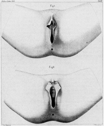 The “Hottentot Apron” da Johannes Mueller, “Ueber die ausseren Geschlechtstheile der Buschmaenninnen”, 1834, in Gilman, 1985, 217